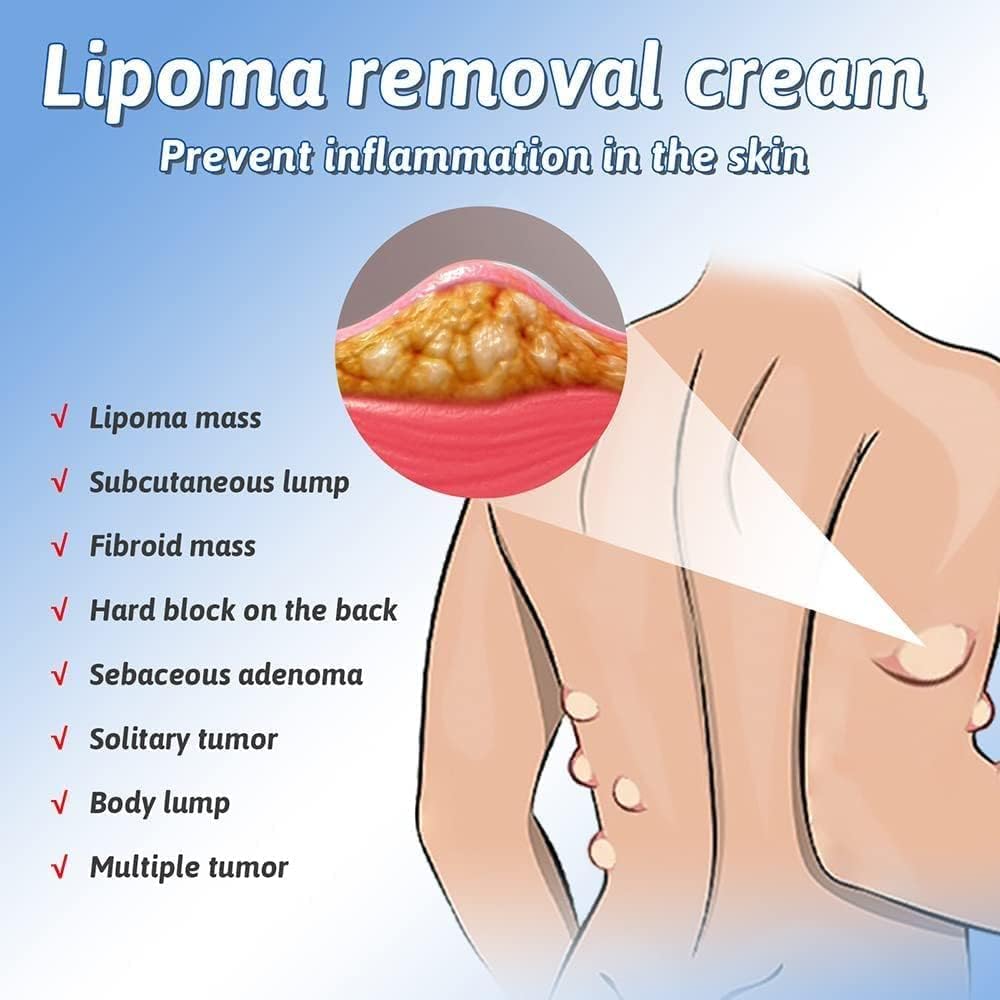 Lepoma Removal Cream