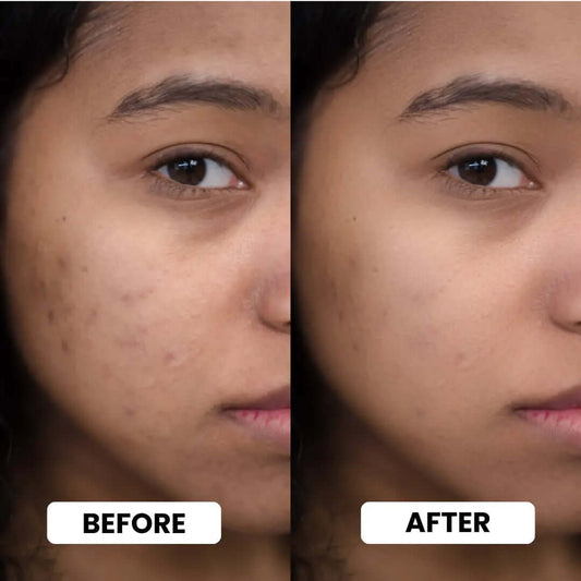Before and after results of using Radiance Ritual Bundle Face Serum on facial skin.