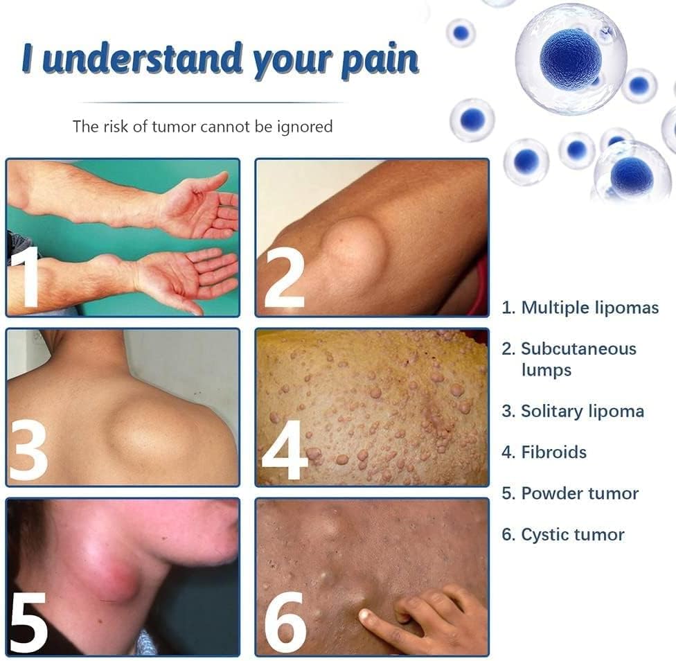 Lepoma Removal Cream