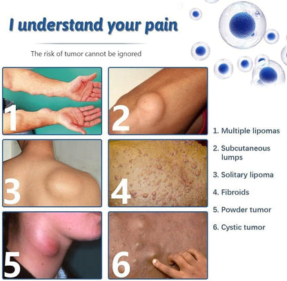Lepoma Removal Cream